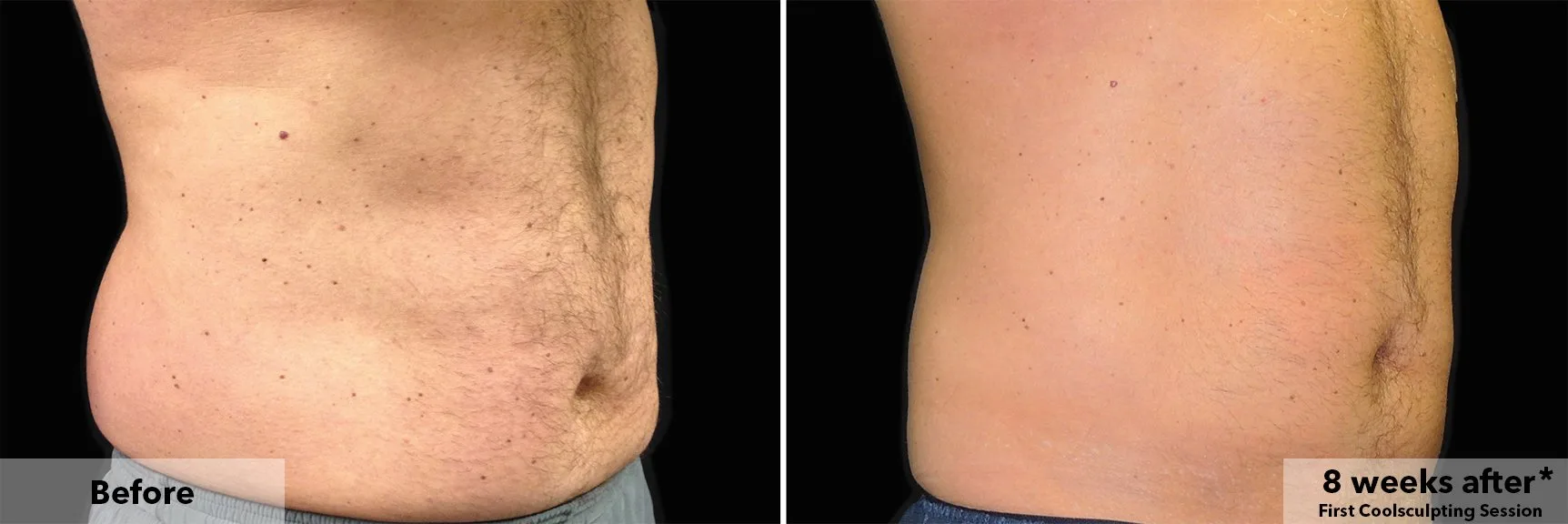 CoolSculpting fat freezing London - before and after photos of the abdomen Abdomen before and after CoolSculpting fat freezing at Cool Clinic in London