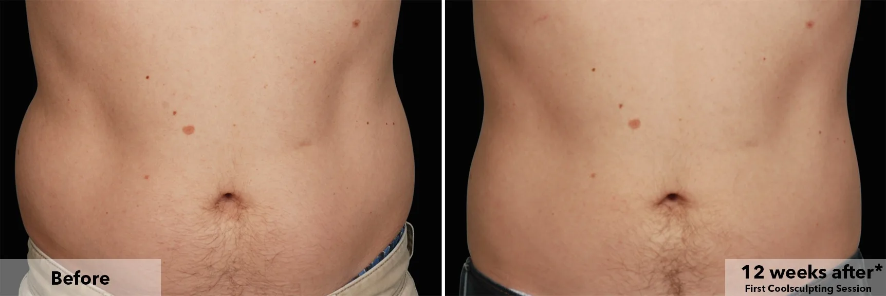 CoolSculpting fat freezing London - before and after photos of the abdomen Abdomen before and after CoolSculpting fat freezing at Cool Clinic in London