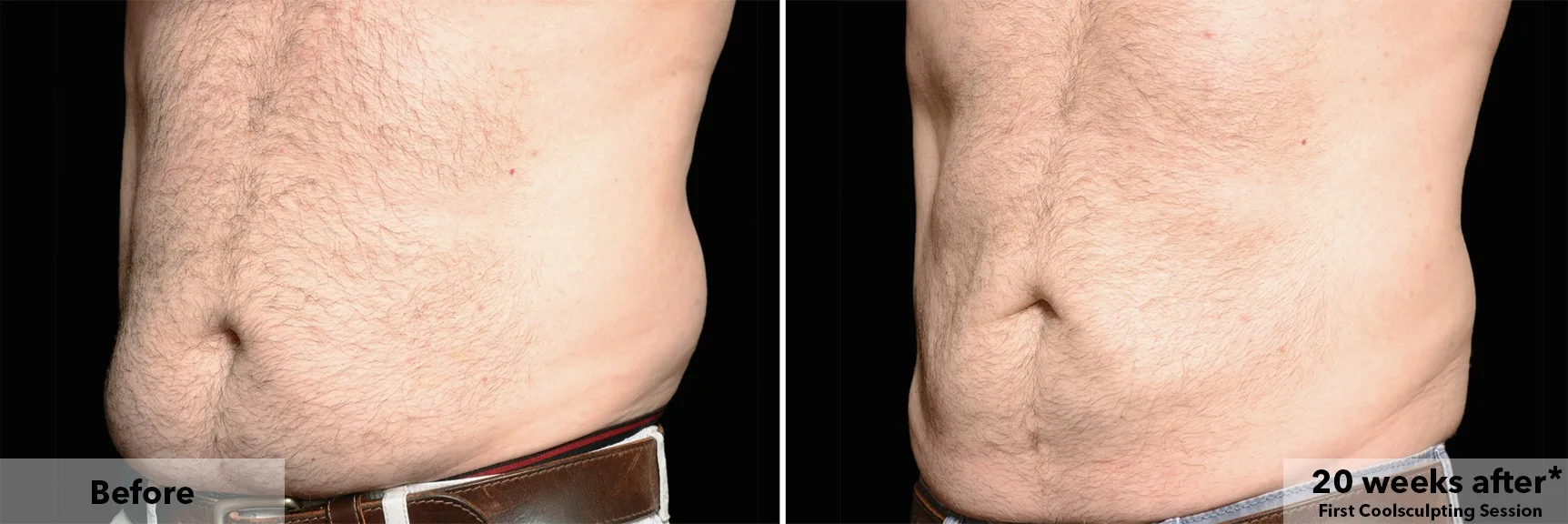 CoolSculpting fat freezing London - before and after photos of the abdomen Abdomen before and after CoolSculpting fat freezing at Cool Clinic in London