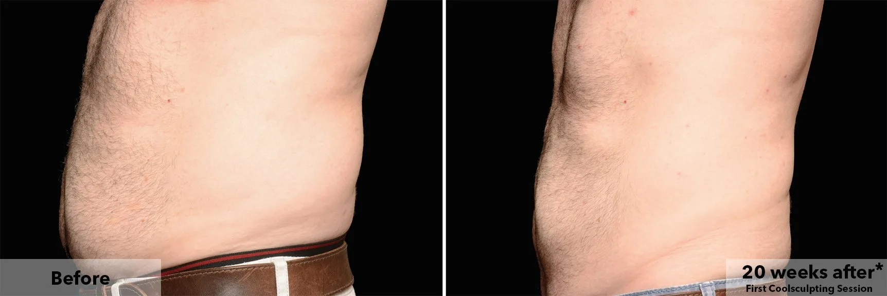 CoolSculpting fat freezing London - before and after photos of the abdomen Abdomen before and after CoolSculpting fat freezing at Cool Clinic in London