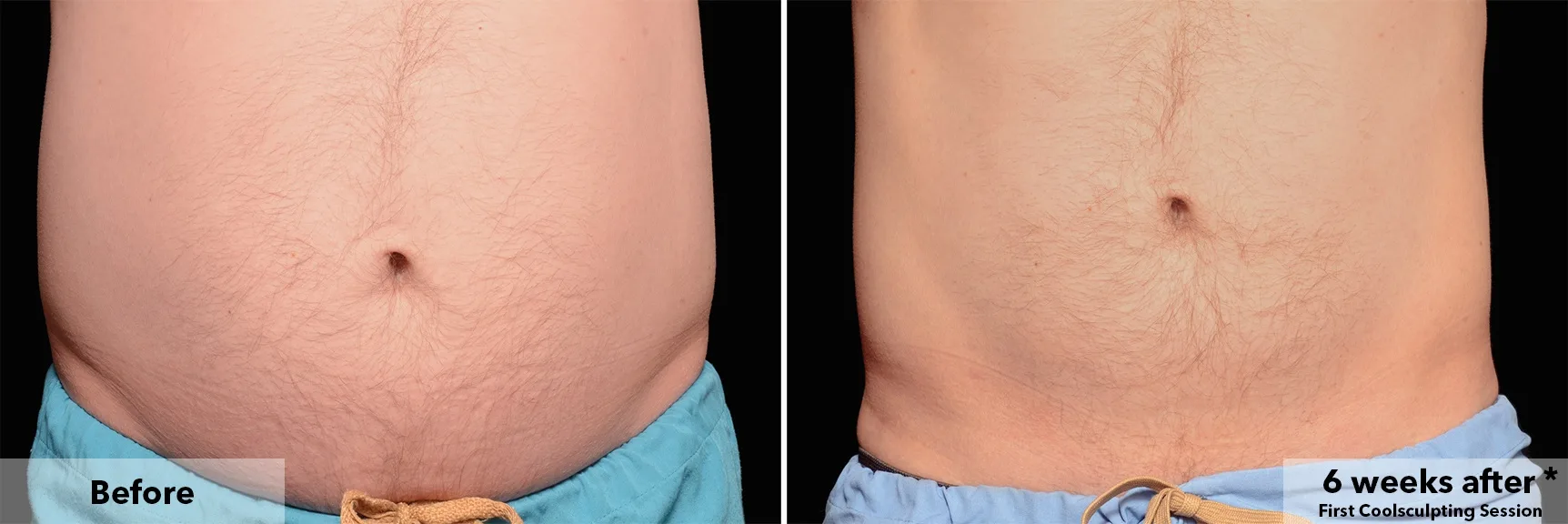 CoolSculpting fat freezing London - before and after photos of the abdomen Abdomen before and after CoolSculpting fat freezing at Cool Clinic in London