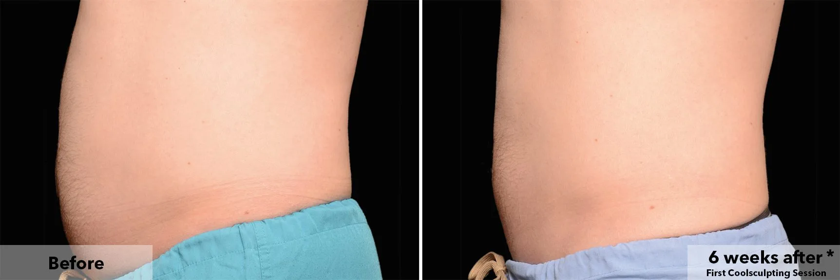CoolSculpting fat freezing London - before and after photos of the abdomen Abdomen before and after CoolSculpting fat freezing at Cool Clinic in London