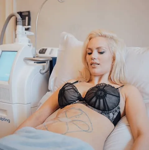 Woman on a treatment couch with treatment areas marked on her abdomen at Cool Clinic, CoolSculpting fat freezing London