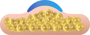 Illustration of an applicator drawing in the fat layer for CoolSculpting fat freezing in London