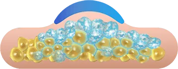 Illustration of fat cells freezing under the applicator for CoolSculpting fat freezing in London