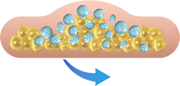Illustration of the treated area being massaged for CoolSculpting fat freezing in London